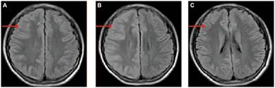 Familial hemiplegic migraine type 2: a case report of an adolescent with ATP1A2 mutation